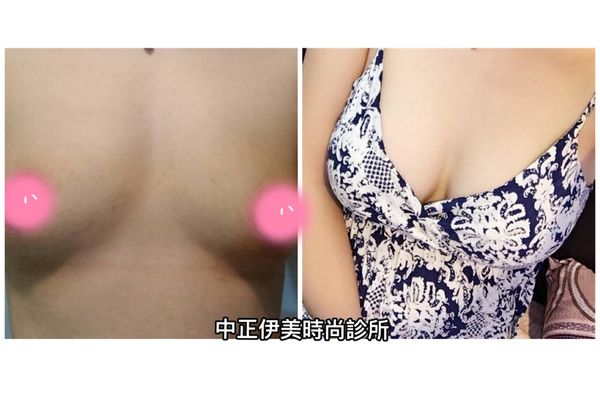 中正伊美果凍隆乳