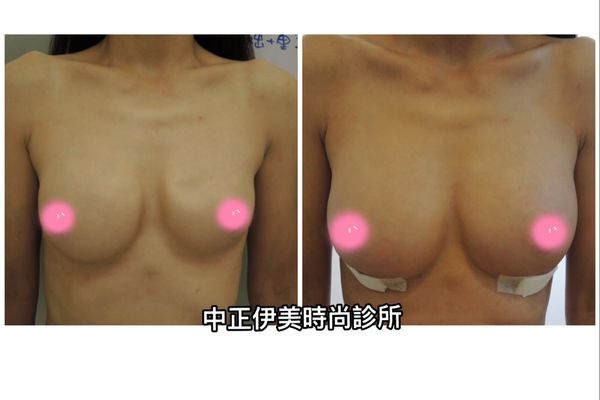 中正伊美果凍隆乳