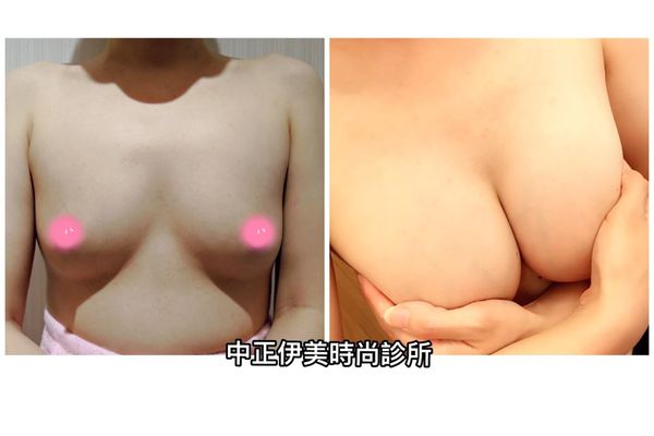 中正伊美果凍隆乳