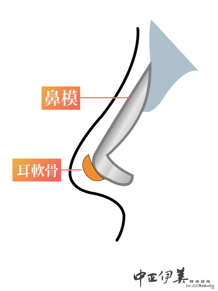 中正伊美隆鼻手術